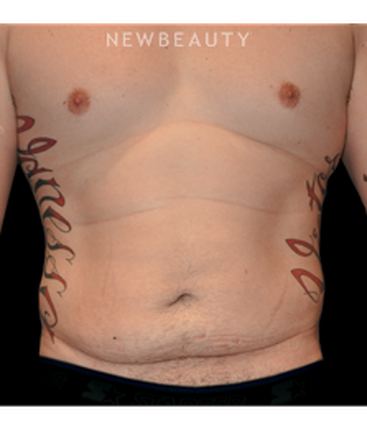 dr-bryan-w-gawley-a-tighter-midsection-b