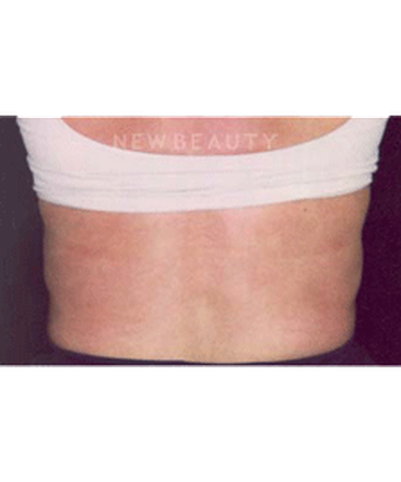 dr-charles-crutchfield-coolsculpting-by-zeltiq-b