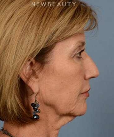 dr-bryan-w-gawley-facial-rejuvenation-b