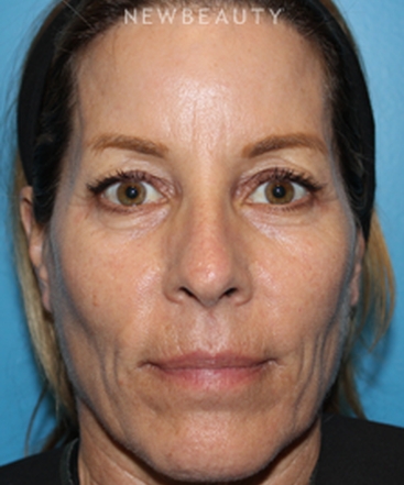 dr-ava-shamban-full-facial-rejuvenation-b