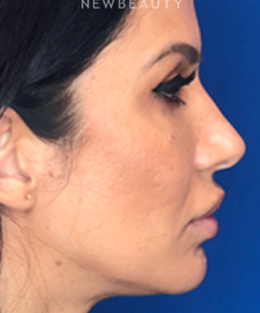 dr-jennifer-levine-rhinoplasty-b