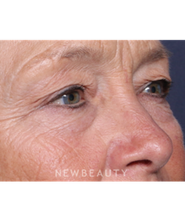 ljcsc-dr-smoot-eyelift-b