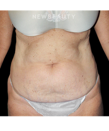 dr-bryan-w-gawley-fit-and-trim-results-b