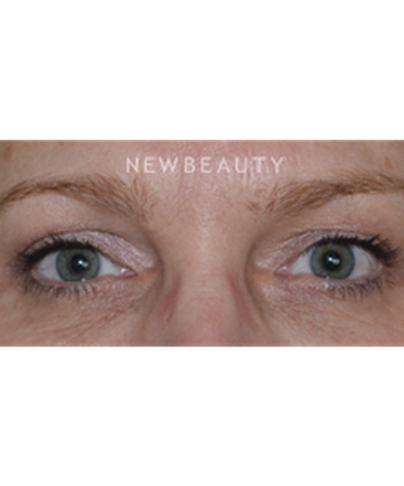 dr-baljeet-k-purewal-blepharoplasties-b