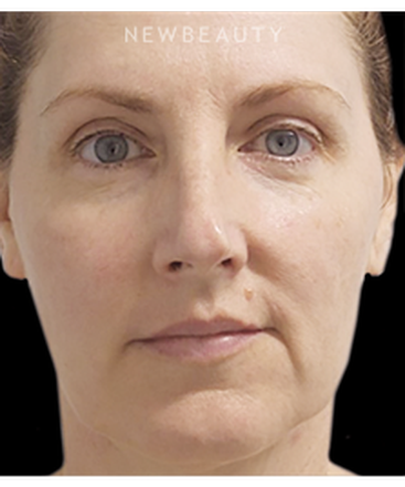 dr-marina-peredo-nonsurgical-lifting-and-tightening-b