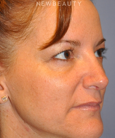 dr-bryan-w-gawley-revision-rhinoplasty-b