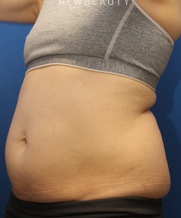 dr-jennifer-levine-sculpsure-b