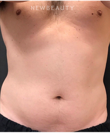 dr-janet-allenby-coolsculpting-b