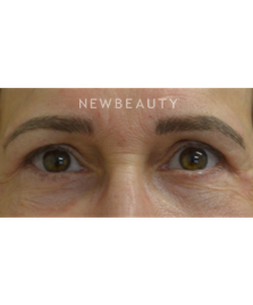 dr-baljeet-purewal-blepharoplasties-b