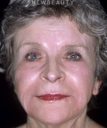 dr-charles-e-crutchfield-botox-b