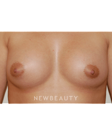 dr-david-rapaport-breast-augmentation-b