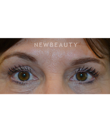 dr-baljeet-k-purewal-upper-blepharoplasty-b