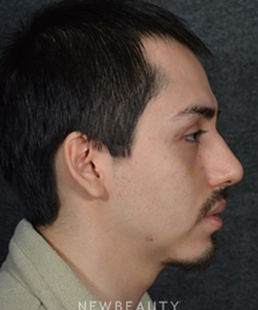 dr-ryan-chastant-rhinoplasty-b