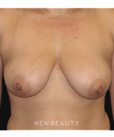 dr-sean-simon-breast-augmentation-breast-lift-b